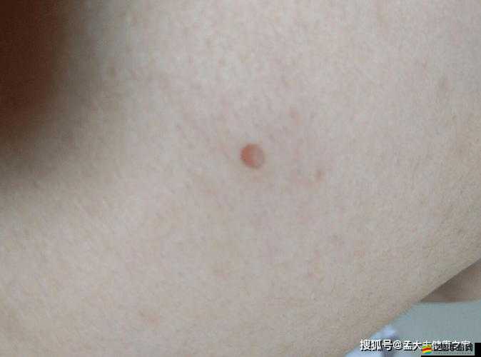 女性三角毛毛區(qū)長(zhǎng)了個(gè)硬疙瘩：可能是什么原因引起該如何處理