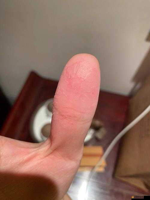 才三根手指就痛：探究這背后令人意想不到的原因